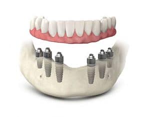 Dental Implants Abroads
