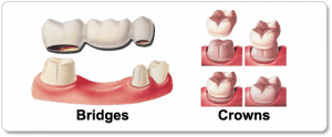 Dental-Crowns-and-Bridges in Costa Rica