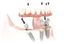 all-on-4-dental-implants-in-costa-rica