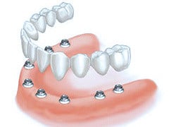 all-on-8-dental-implants-costa-rica