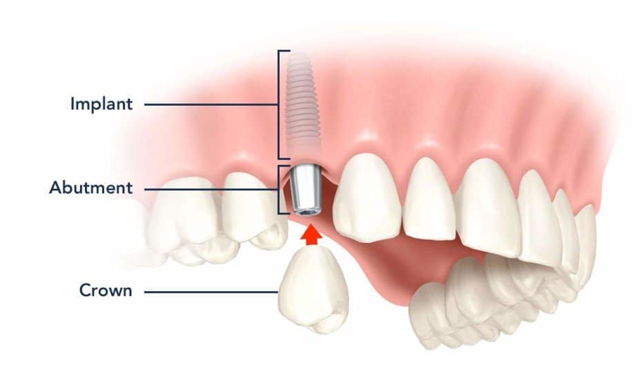 average-cost-of-dental-implants-in-Costa-Rica