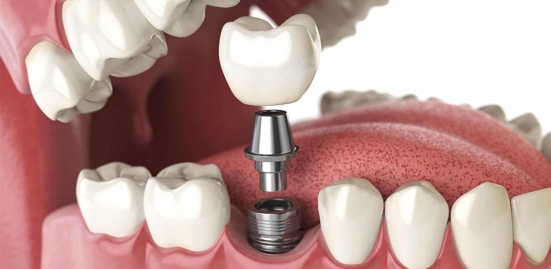 costa-rica-dental-implants