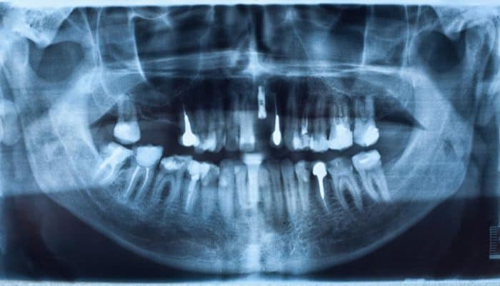 dental-implants-costa-rica