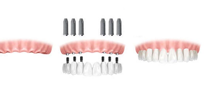 All on Dental Implants in Costa Rica