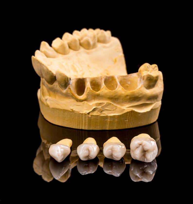 dental implants or dentures Costa Rica