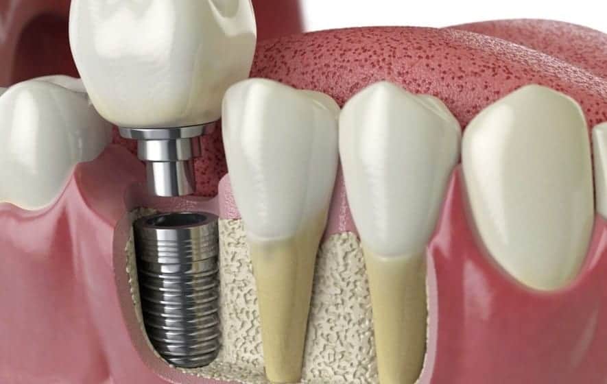 dental-implants-in-costa-rica
