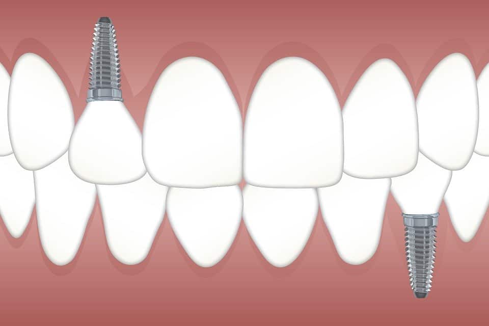 Negative Effects of Dental Implants