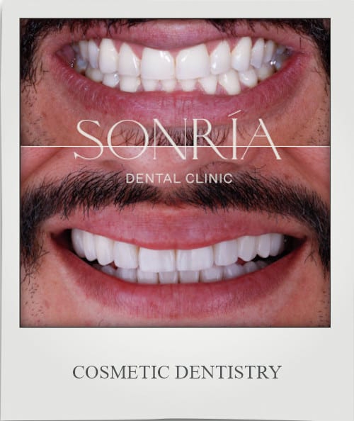 Cosmetic Dentistry in Costa Rica by Sonria Dental Clinic