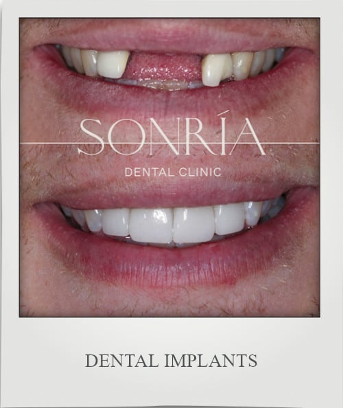 Dental Implants in Costa Rica by Sonria Dental Clinic